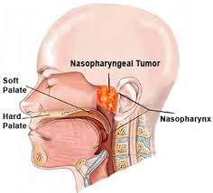 The impact of radiotherapy and concomitant weekly cisplatin on treatment on outcome  of locally advanced nasopharyngeal carcinoma